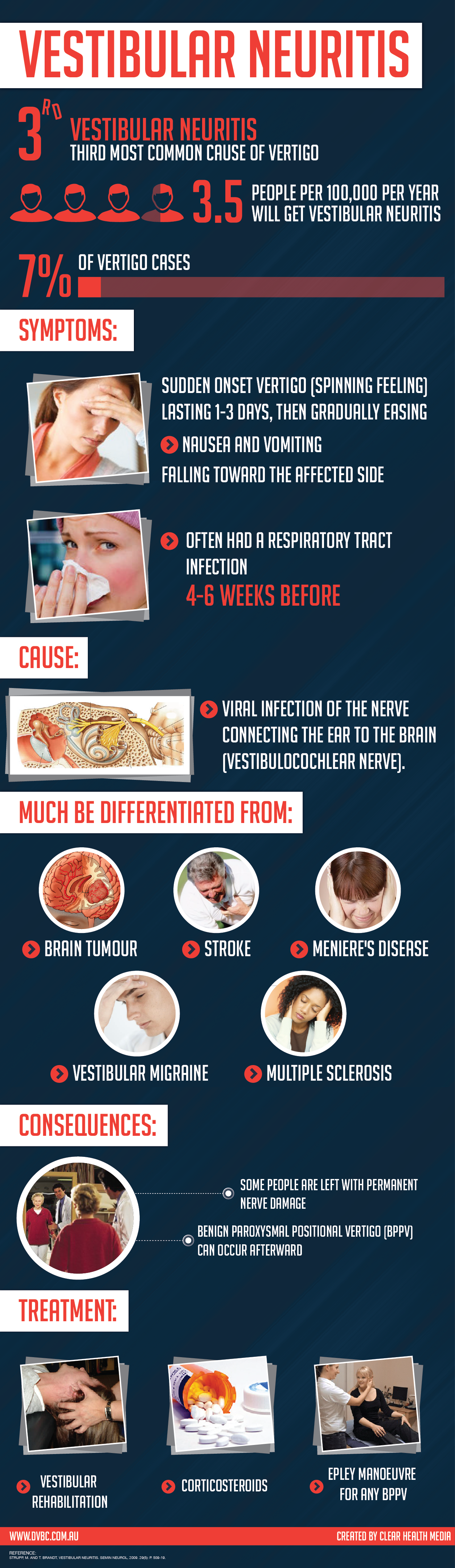 Vestibular Neuritis Infographic